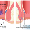 3 remedios naturales para las hemorroides