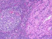 Tiroiditis Hashimoto