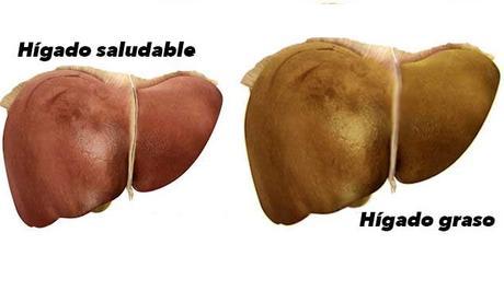 El Higado Graso y las Enfermedades Cardiovasculares