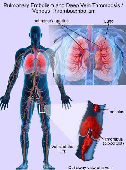 como se produce un tromboembolismo pulmonar