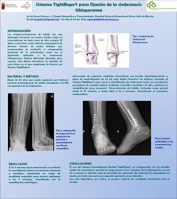 Poster sobre el Sistema TightRope en las Fracturas de Tobillo