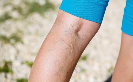 3 ejercicios para aliviar las varices 3 ejercicios para aliviar las varices