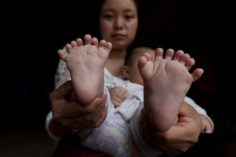 Bebé nació con 31 dedos en China