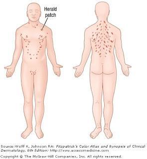 ME HA SALIDO UNA PLACA DESCAMADA Y DÍAS DESPUÉS ME HE LLENADO DE PLACAS… PITIRIASIS ROSADA