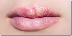 El-herpes-labial El-herpes-labial
