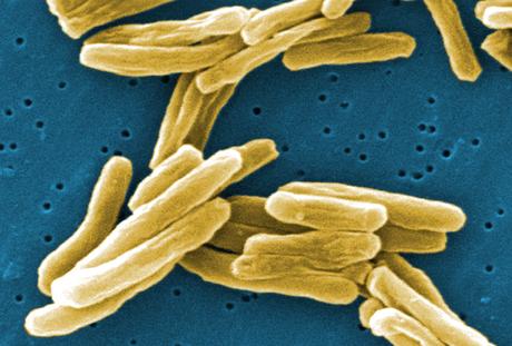Encuentran Nueva Via de Transmision de la Tuberculosis