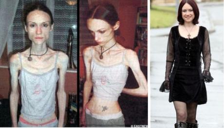 chicas-que-superaron-la-anorexia-4