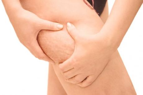 Ingredientes para evitar la celulitis