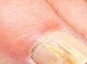 Onicólisis condición donde uñas separan superficie piel espontáneamente