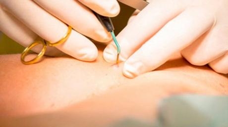 Tipos de quistes de la piel y opciones de tratamiento