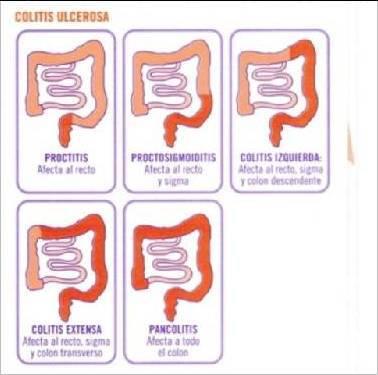 colitis-ulcerosa