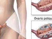 Síndrome ovarios poliquísticos (SOP)