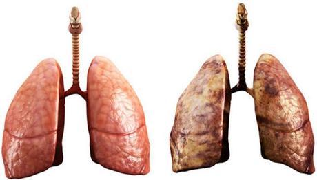 Riesgo de desarrollar cáncer de pulmón después de dejar de fumar