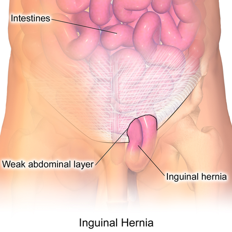 Hernia inguinal: ¿Cómo tratarla?