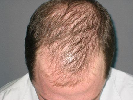 alopecia masculina en m