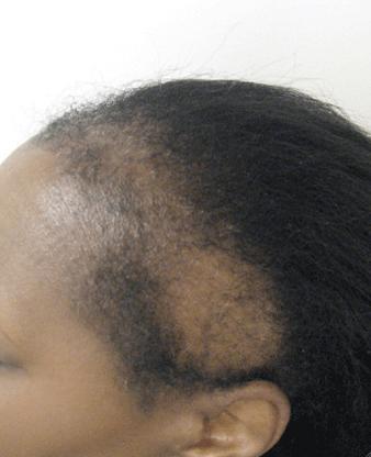 alopecia frontal y temporal por tracción, mujer