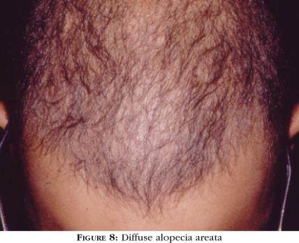 alopecia en parches confluyentes