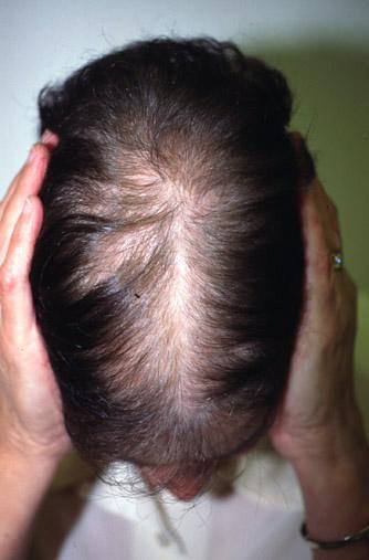 alopecia central, mujer, andrógenos