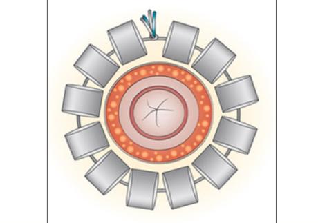 Implantan Dispositivo que elimina la Disfuncion Intestinal