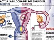 Efectos píldora siguiente