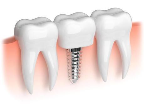 implante dental málaga