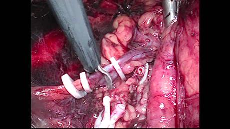 Comprueban la Seguridad de la Nefrectomia Laparoscopica