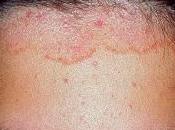 Tratamientos para combatir perdida cabello seborrea.