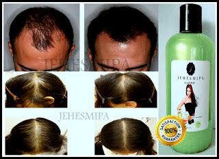 Tratamientos para combatir la perdida de cabello por seborrea.