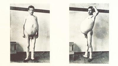 El hombre globo que no podía defecar