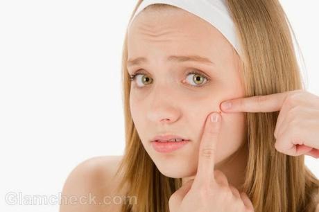 tips y remedios caseros para evitar el acné