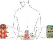 Sistema Neuroestimulación para tratar Dolor Crónico