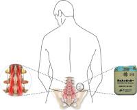 Sistema de Neuroestimulación para tratar el Dolor Crónico