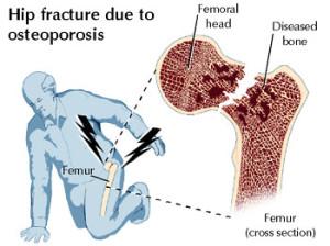 fractura femur osteoporosis fosamax