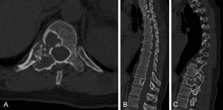 Vertebrectomía Múltiple y re-equilibrio Pélvico