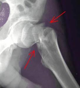 La abuela se fracturó la cadera: ¿y ahora qué hacemos?