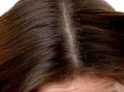 Acaba caspa definitivamente