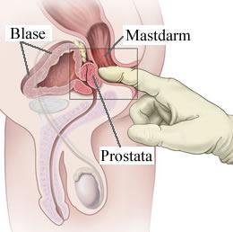 prostata untersuchung 677 Nuevos estudios para detectar el cáncer de próstata
