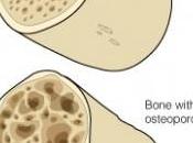 Diagnosticar detectar Osteoporosis