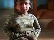 Ramesh Darji "niño piedra".