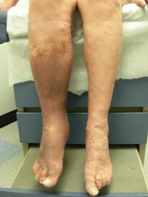 pierna derecha hipercrómica, edematizada, sindrome posttrombostico
