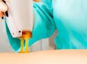 ¿Pensando depilación láser? necesitas saber