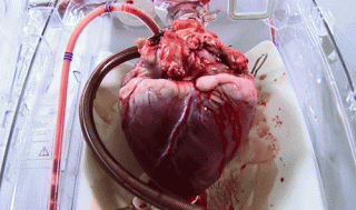 La Insuficiencia Cardiaca cada dia Afecta a mas Personas
