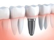 consisten implantes cigomáticos?