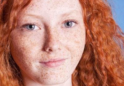 Broncearse y melanoma Broncearse y melanoma