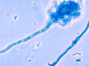 Tricomoniasis: Síntomas tratamiento