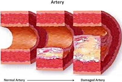 pared arterial rígida y con ateroesclerosis