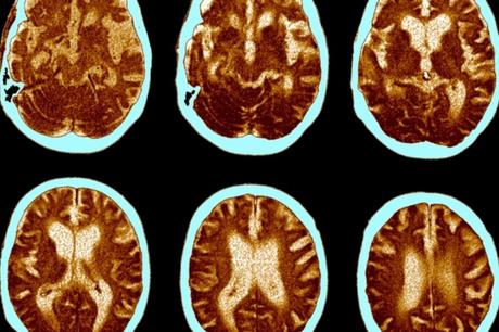 El autismo, el trastorno obsesivo compulsivo y el TDAH, compartirían marcadores cerebrales