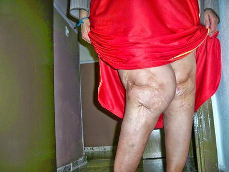 Reclamación al hospital reina Sofía Córdoba 14 años esperando para que me opere