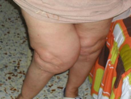 Reclamación al hospital reina Sofía Córdoba 14 años esperando para que me opere