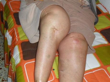 Reclamación al hospital reina Sofía Córdoba 14 años esperando para que me opere